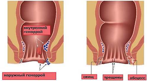 Операция при геморрое