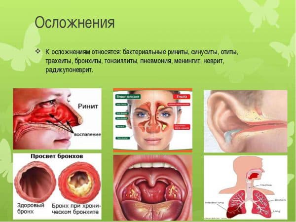 Осложнения хронического тонзиллита