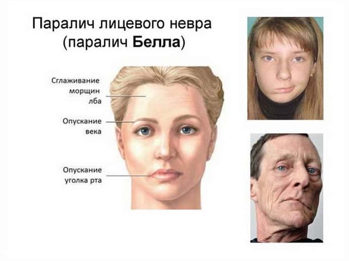 Паралич Белла, патология, затрагивающая область лицевого нерва