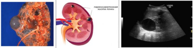 Паренхиматозная киста почки