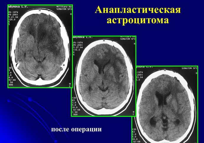 пилоидная астроцитома прогноз