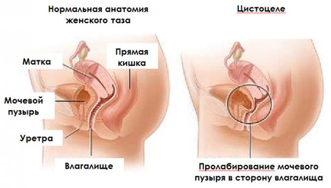 Почему возникает недержание мочи