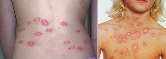 поражение гладкой кожи грибком microsporum
