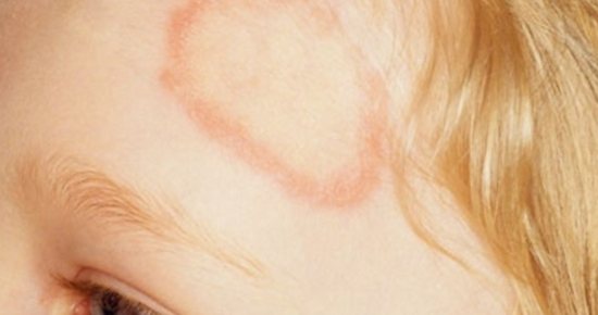 поражение кожи грибком microsporum