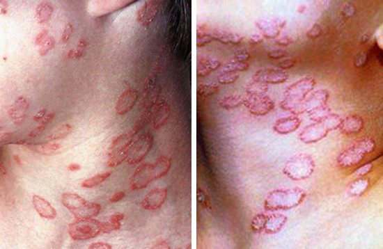 поражение шеи грибком microsporum