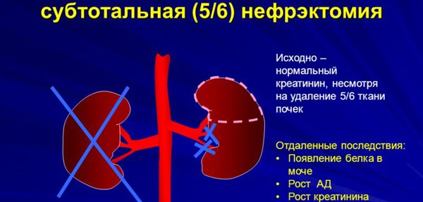 Последствия субтотальной нефрэктомии