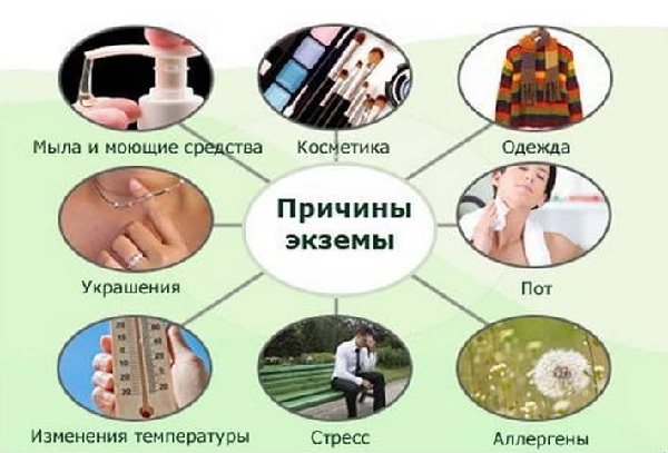 Причины экземы на руках