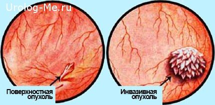 Рак мочевого пузыря: симптомы, признаки, лечение профилактика