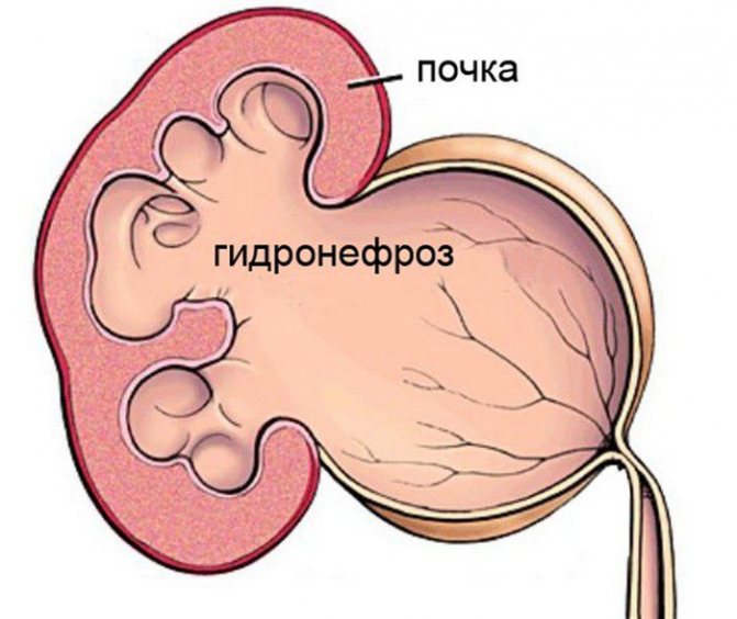 размеры лоханок почек у детей норма