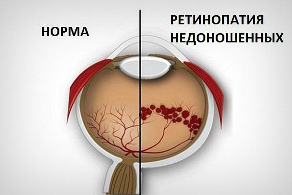 Ретинопатия недоношенных