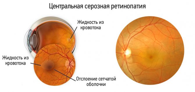 Ретинопатия