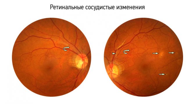 Ретинопатия