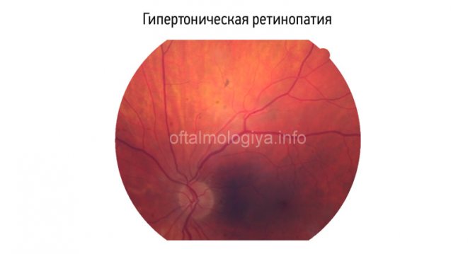 Ретинопатия