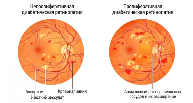 Ретинопатия