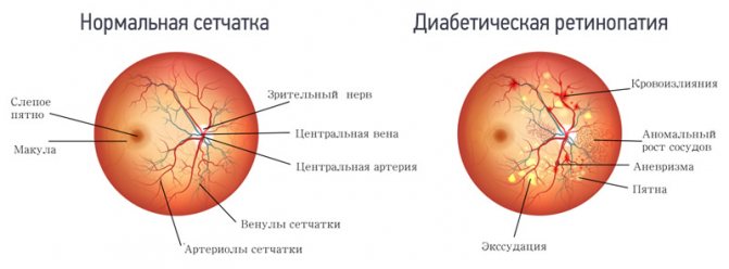 Ретинопатия