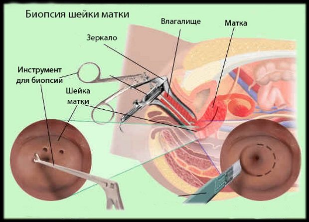 Схема биопсии