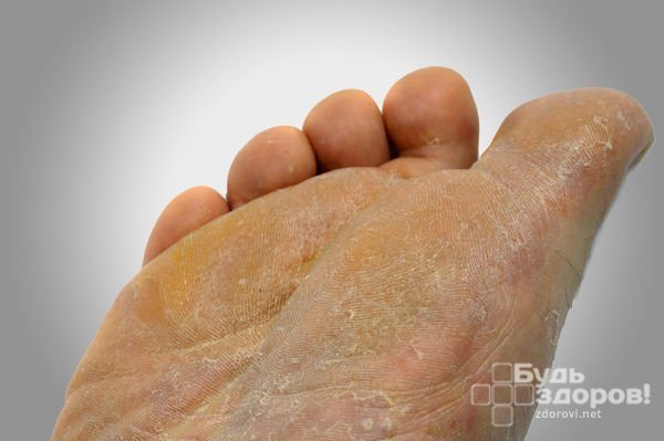 Симптомы грибка стопы