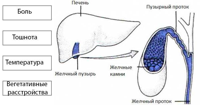 симптомы приступа