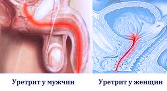 Симптомы уретрита у Женщин и мужчин