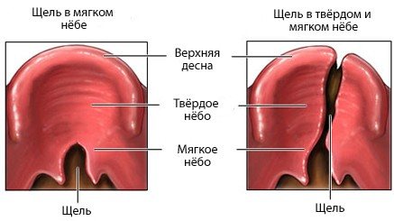 Симптомы волчьей пасти