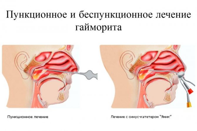 Синус-эвакуация при помощи катетера ЯМИК