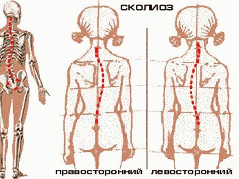 Сколиоз грудного отдела позвоночника