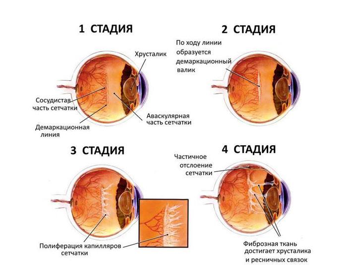 Стадии ретинопатии
