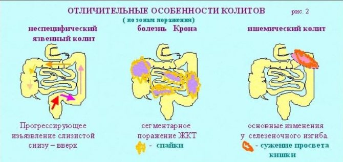 стадии спастического колита