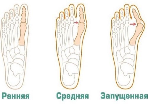 Степени деформации