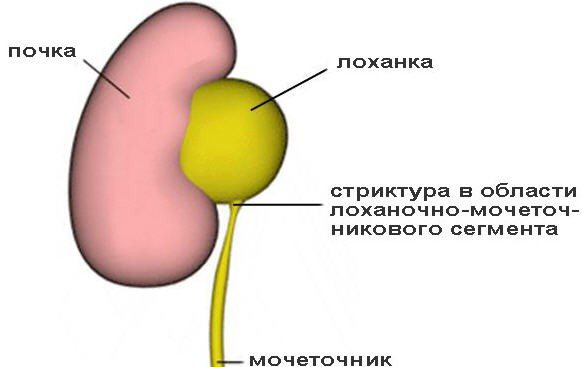 Стриктура мочеточника