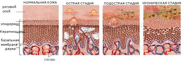 Сухая экзема на руках. Фото, причины и лечение, мази, народные средства