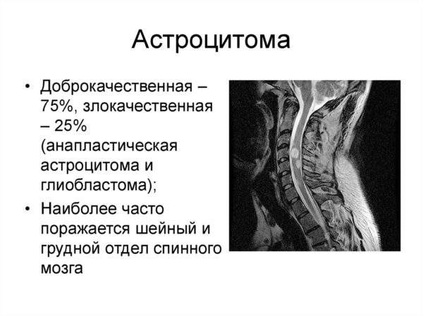 термин статистика астроцитома
