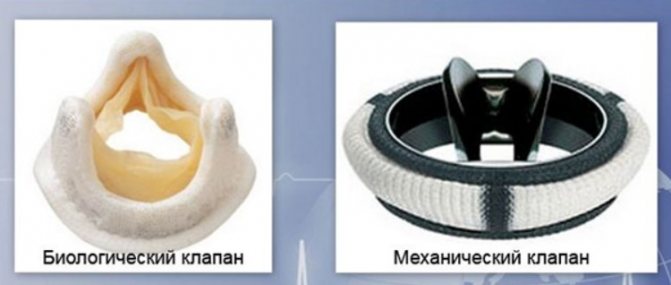 Виды протезов