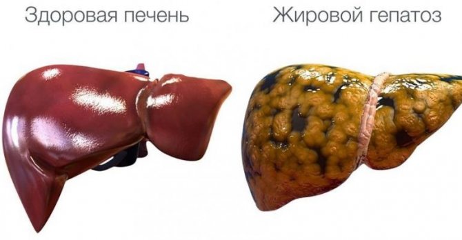 Жировой гепатоз